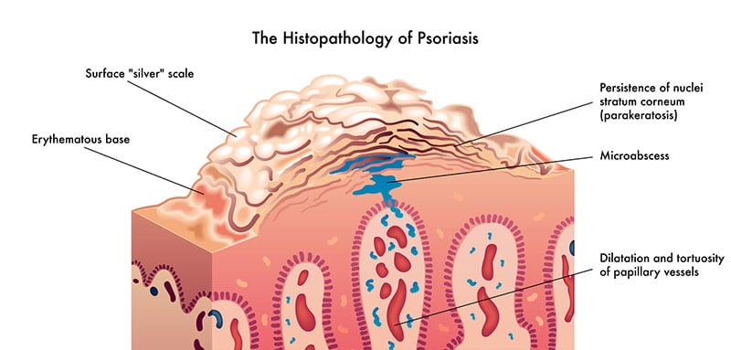 The-Histopathology-of-Psoriasis-Featured-Image